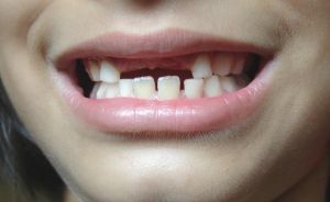children-loose-teeth